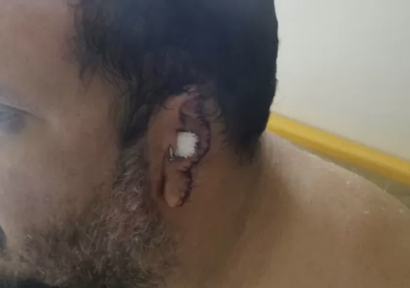 Homem perde parte da orelha após reagir a tentativa de assalto em Campo Grande
