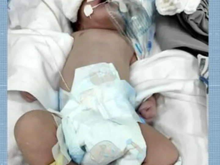 Sem neurocirurgião, cirurgia urgente de bebê é adiada na Santa Casa e família faz apelo