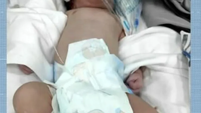 Sem neurocirurgião, cirurgia urgente de bebê é adiada na Santa Casa e família faz apelo